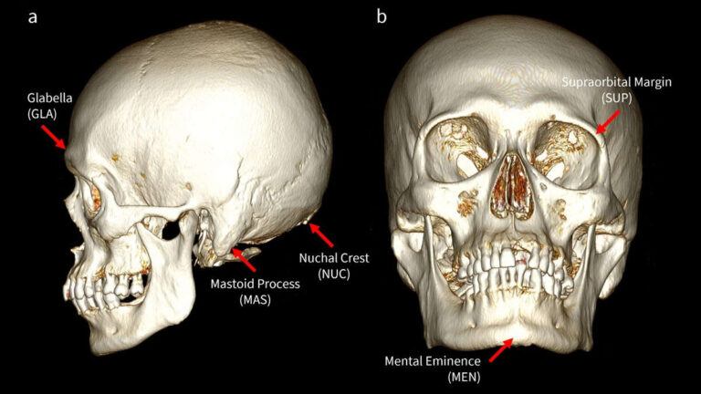 New Forensic tool to determine the biological sex of the skull