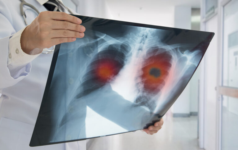 There is a growing number of cases of lung cancer of people who have never smoked.